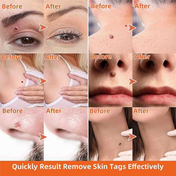 Moisturizing Facial Wart Remover - Image 5