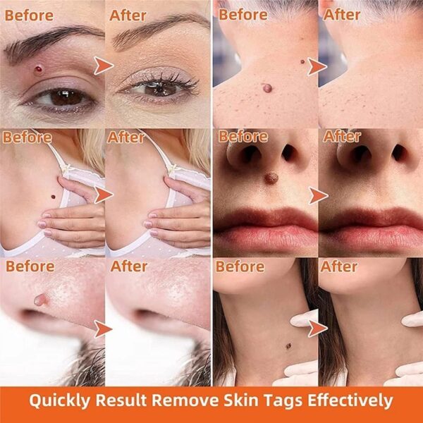 Moisturizing Facial Wart Remover - Image 6